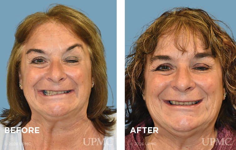 Patient with synkinesis before and after left DAO resection.